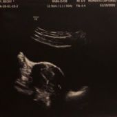 Aveline Hope 2.12.20 Ectopic Loss Support Fort Collins